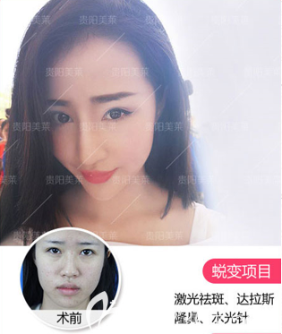 貴陽美萊隆鼻好不好？