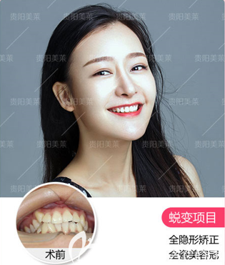貴陽美萊哪個醫(yī)生做牙齒矯正好