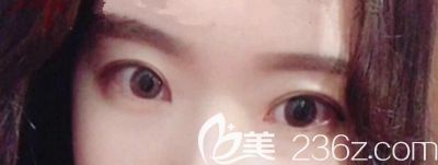 在韓國本愛做眼綜合手術1個月 在韓國本愛做眼綜合手術1個月