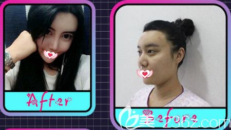 邯鄲華美4月整形又降價(jià) 硅膠隆鼻和微針美塑優(yōu)惠活動價(jià)為3080元