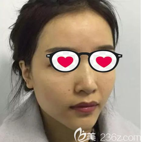 呼和浩特京美整形醫(yī)院朱京成院長(zhǎng)鼻綜合隆鼻前 呼和浩特京美整形醫(yī)院朱京成院長(zhǎng)鼻綜合隆鼻前