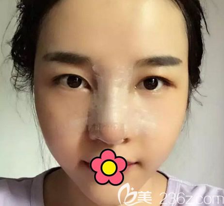 京美整形朱京成自體軟骨隆鼻第五天效果 京美整形朱京成自體軟骨隆鼻第五天效果