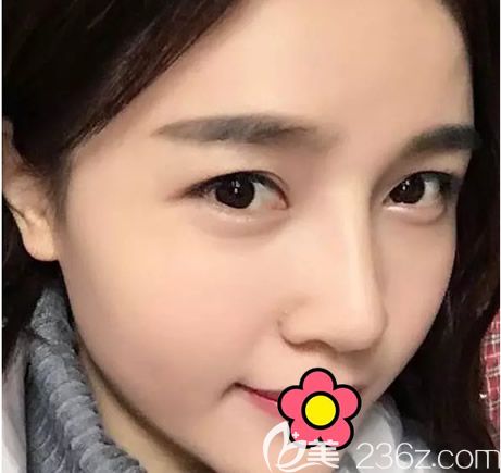 呼市京美假體隆鼻+自體軟骨隆鼻一個(gè)月的恢復(fù)效果怎么樣 呼市京美假體隆鼻+自體軟骨隆鼻一個(gè)月的恢復(fù)效果怎么樣