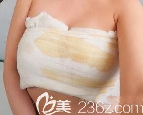 我在南寧東方整形做自體脂肪隆胸術(shù)后當天 我在南寧東方整形做自體脂肪隆胸術(shù)后當天