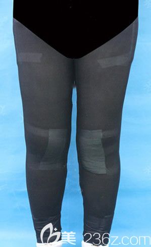 大腿吸脂和小腿吸脂第1天