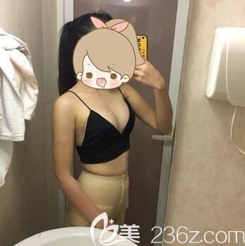 我在南寧東方整形做自體脂肪豐胸第7天拆線效果 我在南寧東方整形做自體脂肪豐胸第7天拆線效果