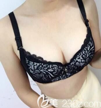 我在南寧東方做大腿吸脂和自體脂肪隆胸第15天 我在南寧東方做大腿吸脂和自體脂肪隆胸第15天