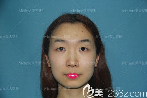 在承德美天做眼綜合手術(shù)前是無神單眼皮 在承德美天做眼綜合手術(shù)前是無神單眼皮