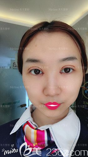 郭東超醫(yī)生為我做眼綜合手術(shù)后4天消腫不少 郭東超醫(yī)生為我做眼綜合手術(shù)后4天消腫不少