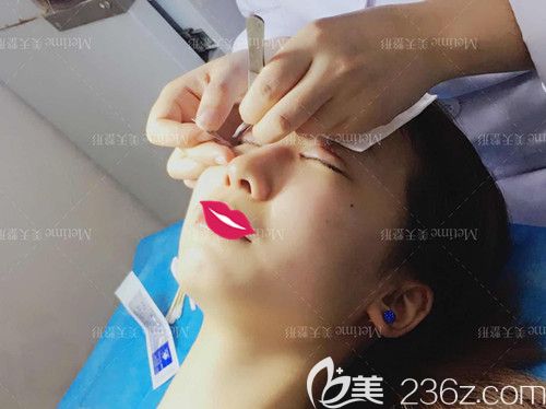 在承德美天做雙眼皮和開眼角手術(shù)7天進行拆線 在承德美天做雙眼皮和開眼角手術(shù)7天進行拆線