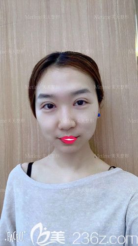 郭東超醫(yī)生為我做眼綜合手術(shù)15天眼睛基本恢復(fù) 郭東超醫(yī)生為我做眼綜合手術(shù)15天眼睛基本恢復(fù)