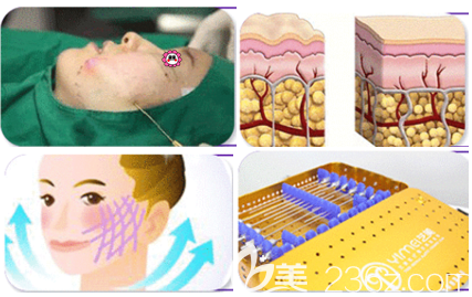 北京藝美不開刀降顴骨/縮下頜角手術(shù)示意圖