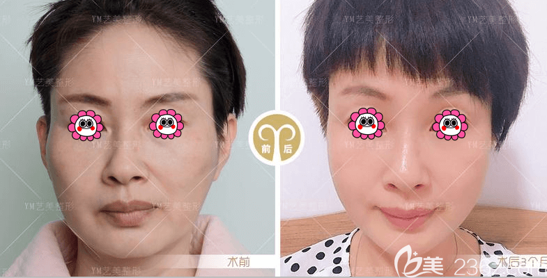 北京藝美鞏敏醫(yī)生不開刀降顴骨顴弓案例