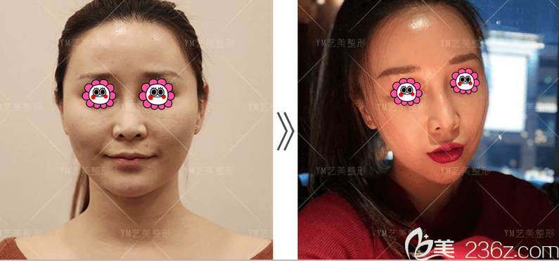 北京藝美王東醫(yī)生不開刀降低顴弓顴弓縮下頜角案例