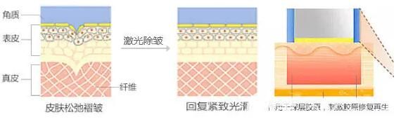 激光美膚的原理 激光美膚的原理
