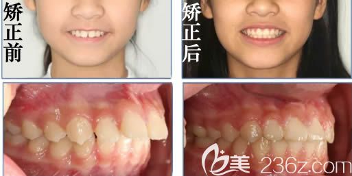 譚暉青少年齙牙矯正案例及臉型變化圖 譚暉青少年齙牙矯正案例及臉型變化圖