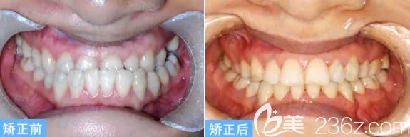 北京維樂口腔成人地包天矯正案例效果 北京維樂口腔成人地包天矯正案例效果