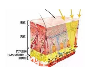 激光除皺的原理 激光除皺的原理