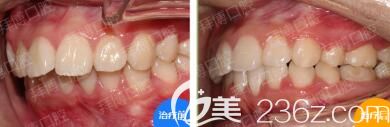 洛陽拜博口腔畢芳牙齒矯正案例