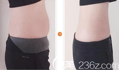 腰腹吸脂手術案例