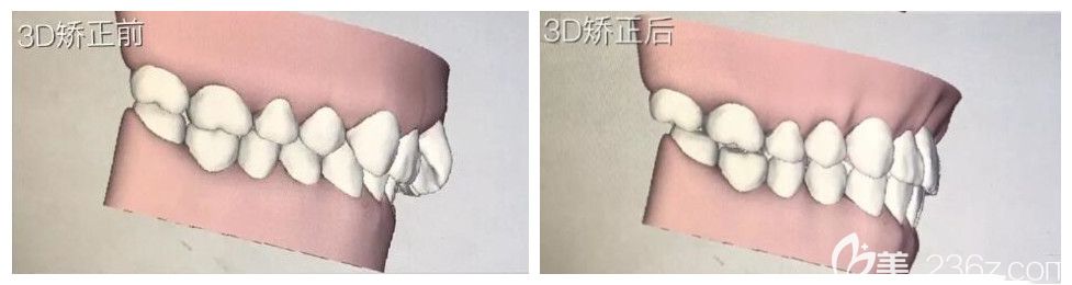 3D對比圖，牙齒內(nèi)收很多