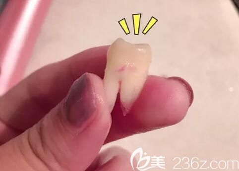 去洛陽拜博口腔矯正前拔掉的智齒