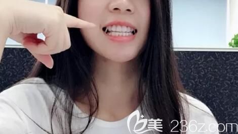 拜博口腔戴隱形牙套打骨釘，掛橡皮筋圖