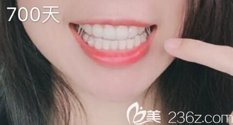 32歲時我找洛陽拜博口腔畢芳做了隱形矯正，戴牙套700天讓大家看看我的效果