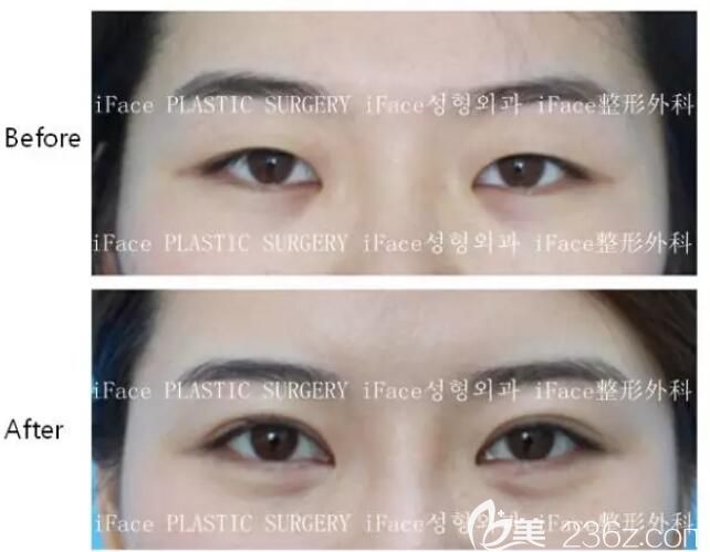 金范晉雙眼皮案例對比 金范晉雙眼皮案例對比