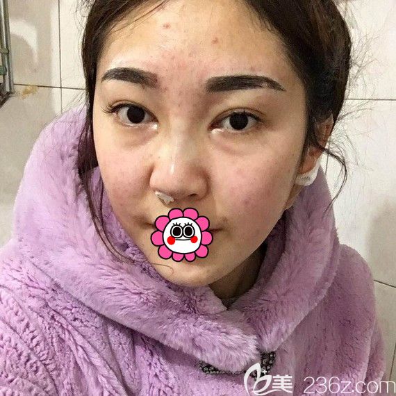在哈爾濱索菲做完鼻綜合即刻效果