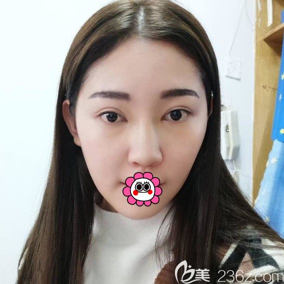 陳富全鼻綜合術(shù)后第8天