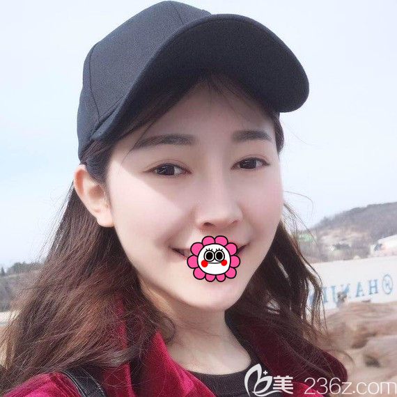 哈爾濱索菲陳富全鼻綜合術(shù)后不用固定無需包扎原來是真的，這是我做完兩個月的恢復案例和價格表