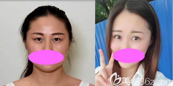 我在九江星瑞美割雙眼皮前后 我在九江星瑞美割雙眼皮前后