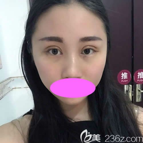 九江星瑞美雙眼皮手術(shù)7天 九江星瑞美雙眼皮手術(shù)7天