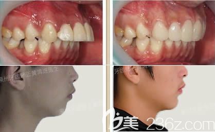 泉州維樂口腔黃鴻進(jìn)牙齒正畸效果圖 泉州維樂口腔黃鴻進(jìn)牙齒正畸效果圖