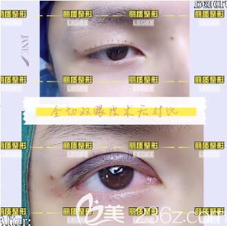 <!--<i data=20240703-sp></i>-->麗質醫(yī)療美容醫(yī)院全切雙眼皮真人