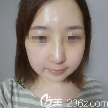 在韓國(guó)本愛(ài)做面部輪廓+鼻修復(fù)術(shù)后1個(gè)月 在韓國(guó)本愛(ài)做面部輪廓+鼻修復(fù)術(shù)后1個(gè)月