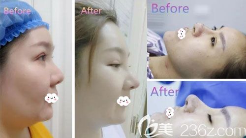 金成鎬鼻綜合隆鼻整形案例 金成鎬鼻綜合隆鼻整形案例