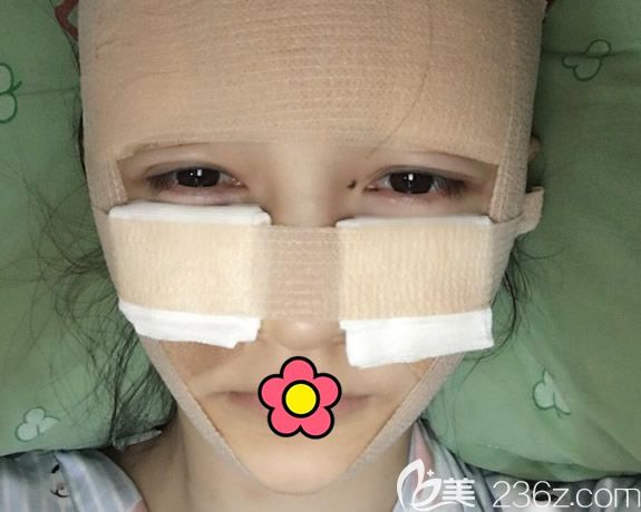 呼市京美李發(fā)成臉部脂肪填充第1天效果