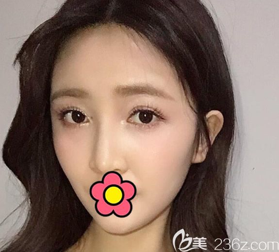 呼市京美李發(fā)成全臉脂肪填充第5天照片