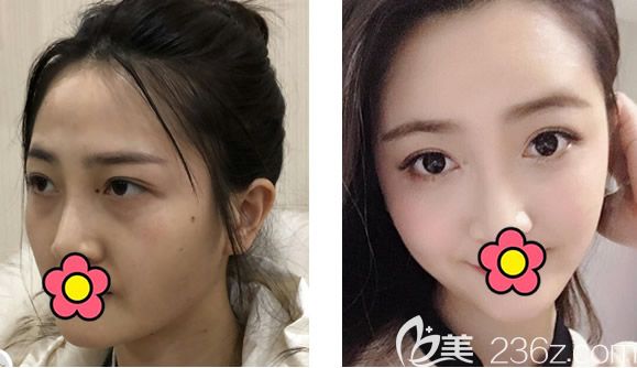 呼和浩特京美整形醫(yī)院全臉脂肪填充對比圖