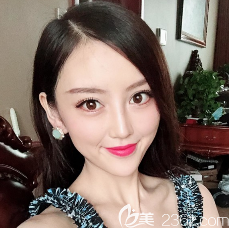 廣州做埋線提升哪家醫(yī)院好？看我花38000元找廣州天姿做的悅升線雕提升效果怎么樣？