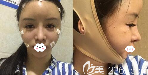 自體脂肪面部填充+面部吸脂術(shù)后即刻效果 自體脂肪面部填充+面部吸脂術(shù)后即刻效果