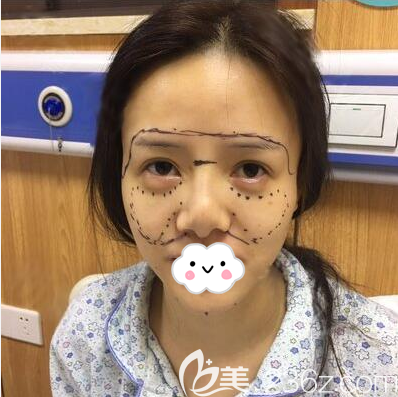 成都西區(qū)醫(yī)院毛健清脂肪填充術(shù)前設(shè)計(jì) 成都西區(qū)醫(yī)院毛健清脂肪填充術(shù)前設(shè)計(jì)