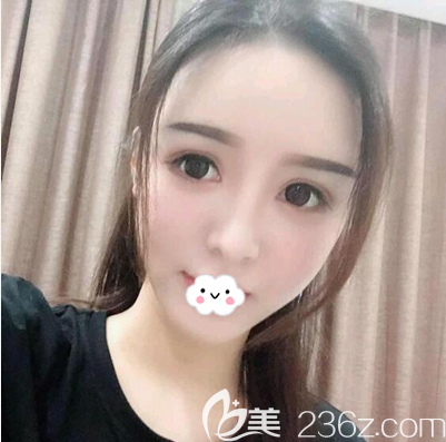 毛健清全面部脂肪填充術(shù)后3個(gè)月效果 毛健清全面部脂肪填充術(shù)后3個(gè)月效果