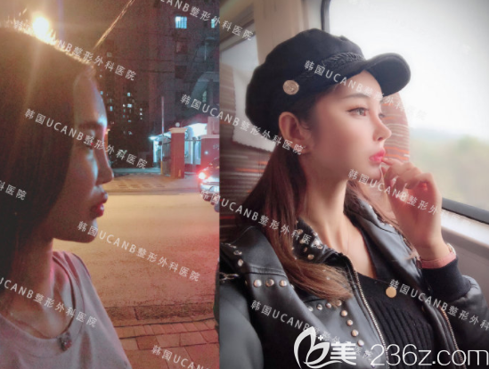 李芳碩院長鼻部修復(fù)案例