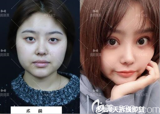 貴陽美萊雙眼皮案例