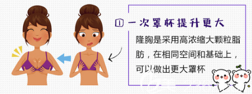 自體脂肪填充示意圖 自體脂肪填充示意圖