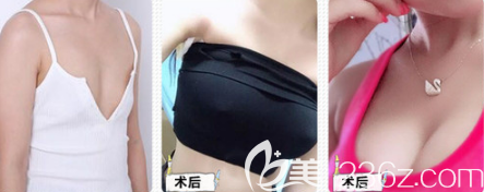 自體脂肪豐胸案例 自體脂肪豐胸案例