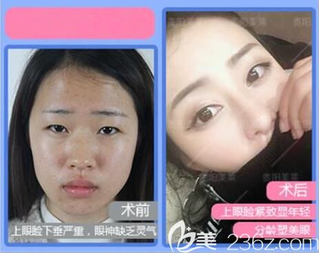 貴陽美萊急速雙眼皮